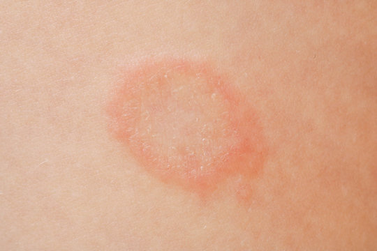 Ringworm | Ask Dr Sears